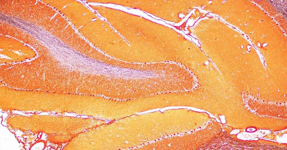 Cracking the code to unlock brain diseases